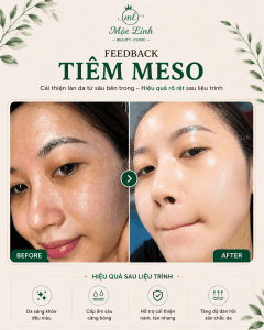 Tiêm Meso Hải Phòng