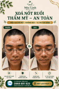 Xoá nốt ruồi an toàn Hải Phòng