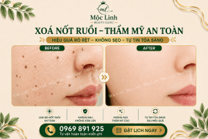 Xoá nốt ruồi an toàn Hải Phòng