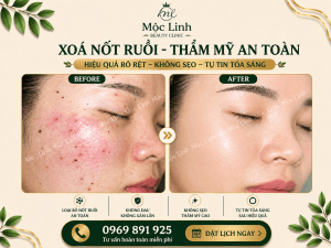 Xoá nốt ruồi an toàn Hải Phòng