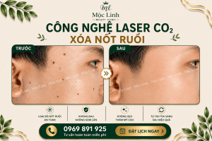 Xoá nốt ruồi an toàn Hải Phòng