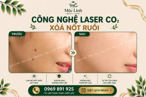 Xoá nốt ruồi an toàn Hải Phòng