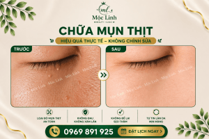 Điều trị mụn thịt uy tín tại Hải Phòng