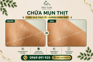 Điều trị mụn thịt uy tín tại Hải Phòng