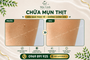 Điều trị mụn thịt uy tín tại Hải Phòng