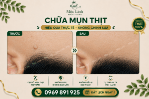 Điều trị mụn thịt uy tín tại Hải Phòng