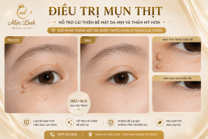 Điều trị mụn thịt uy tín tại Hải Phòng