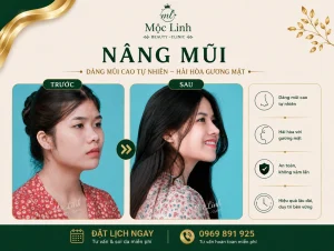 Nâng Mũi Uy Tín Tại Hải Phòng