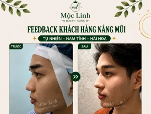 Nâng Mũi Uy Tín Tại Hải Phòng