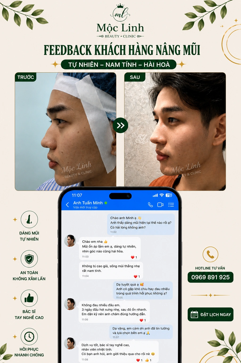Công nghệ nâng mũi hiện đại tại Thẩm Mỹ Mộc Linh Hải Phòng