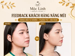 Nâng Mũi Uy Tín Tại Hải Phòng