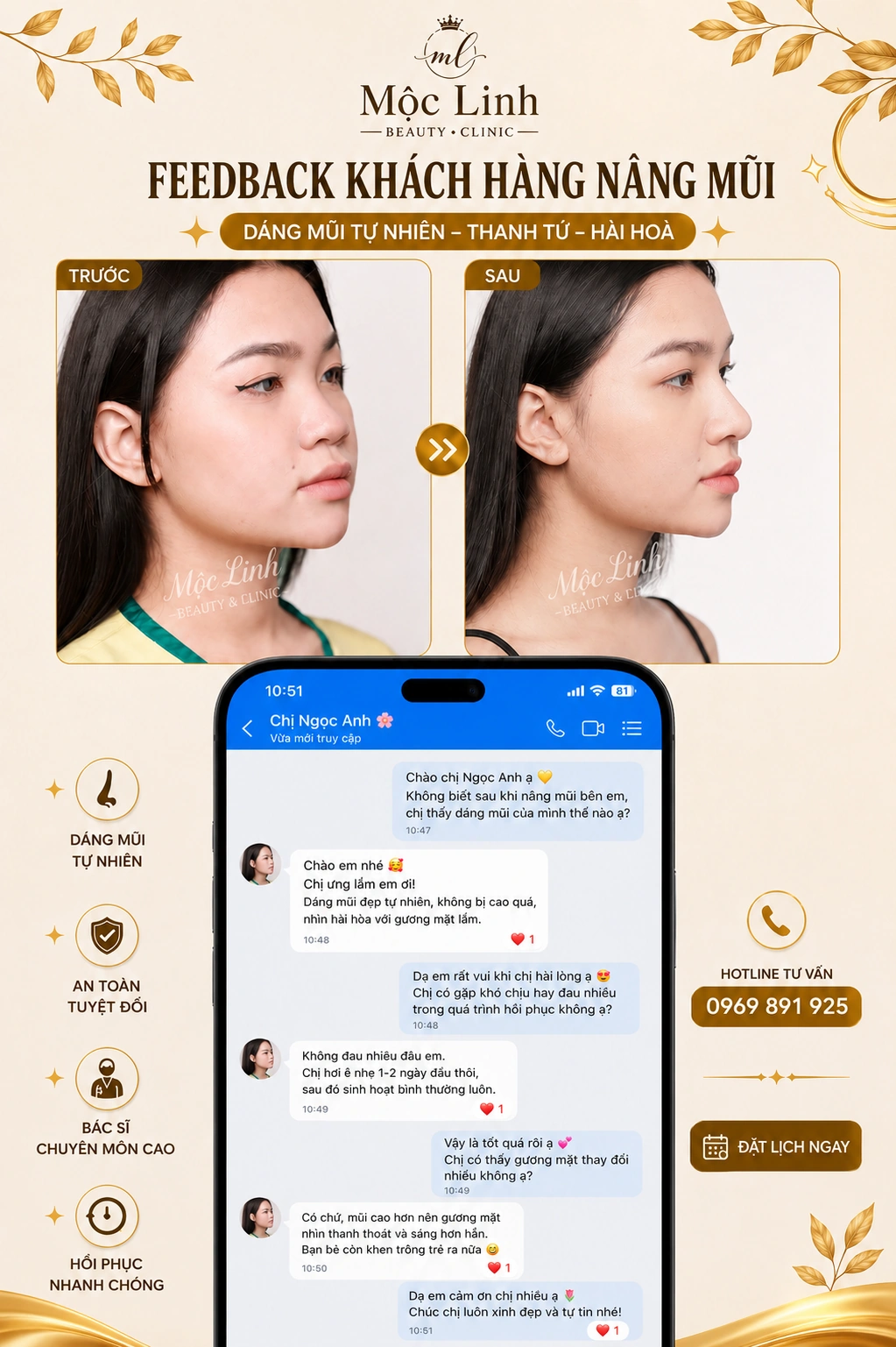 Khách hàng nâng mũi tại Thẩm Mỹ Mộc Linh Hải Phòng