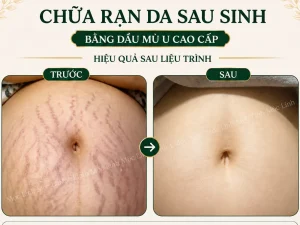 Chữa rạn da Hải Phòng