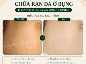 Chữa rạn da Hải Phòng