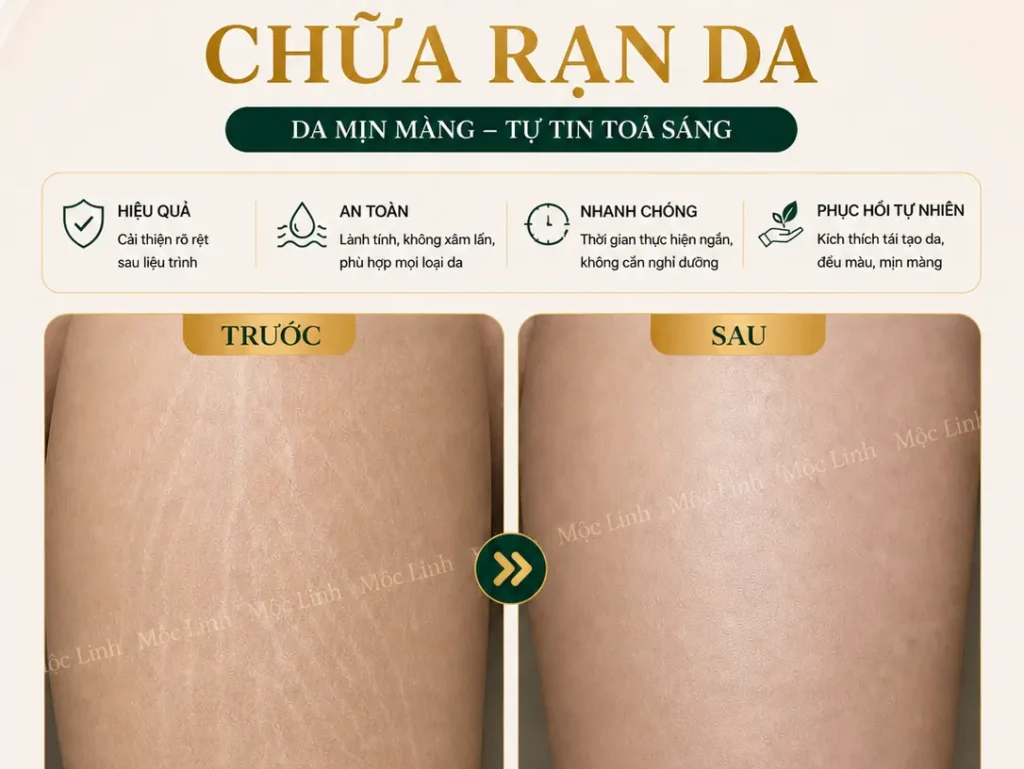 Chữa rạn da Hải Phòng