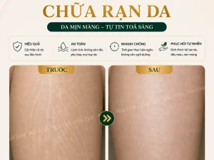 Chữa rạn da Hải Phòng