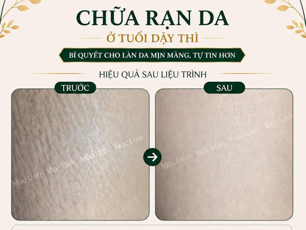 Chữa rạn da Hải Phòng