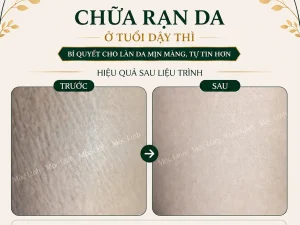 Chữa rạn da Hải Phòng