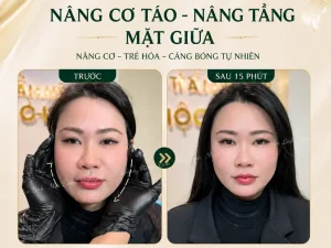 Nâng cơ táo (Căng chỉ) uy tín tại Hải Phòng