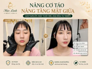 Nâng cơ táo (Căng chỉ) uy tín tại Hải Phòng