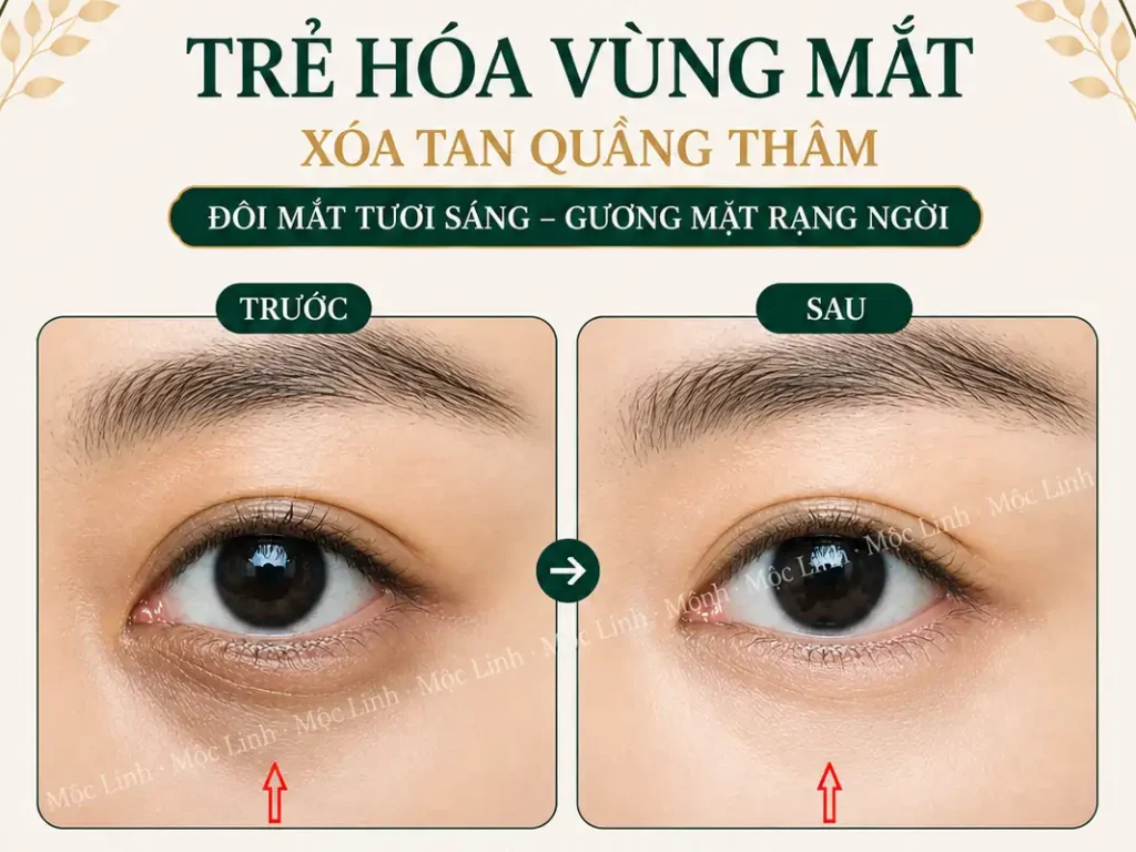 Chữa thâm mắt uy tín Hải Phòng
