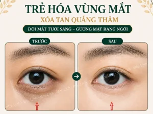 Chữa thâm mắt uy tín Hải Phòng