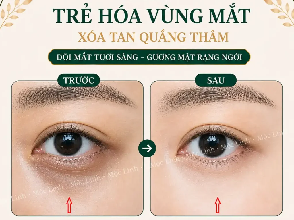 Chữa thâm mắt uy tín Hải Phòng