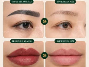 Xoá xăm mày – môi Hải Phòng