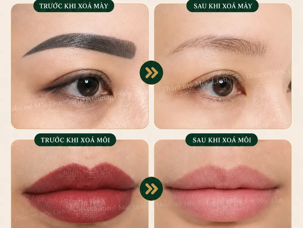 Xoá xăm mày – môi Hải Phòng