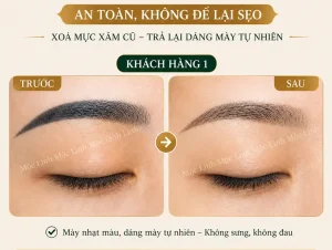 Xoá xăm mày – môi Hải Phòng