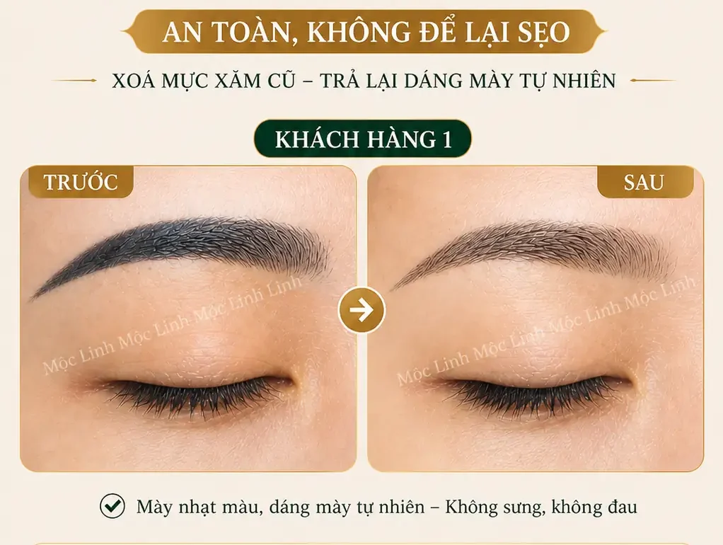 Xoá xăm mày – môi Hải Phòng