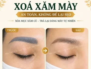 Xoá xăm mày – môi Hải Phòng