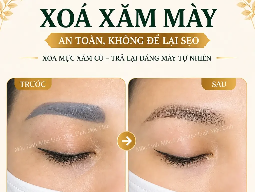 Xoá xăm mày – môi Hải Phòng