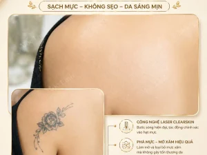 Xoá hình xăm Hải Phòng