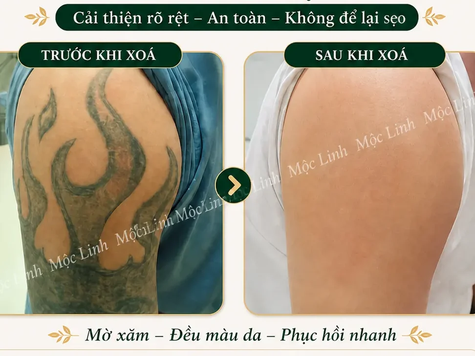 Xoá hình xăm Hải Phòng