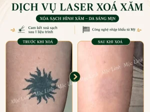 Xoá hình xăm Hải Phòng