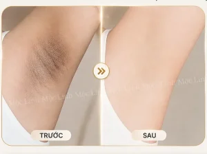Trị thâm nách – bẹn Hải Phòng