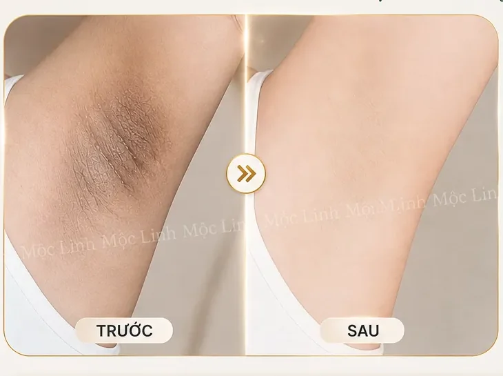 Trị thâm nách – bẹn Hải Phòng