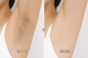 Trị thâm nách – bẹn Hải Phòng