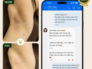 Trị thâm nách – bẹn Hải Phòng