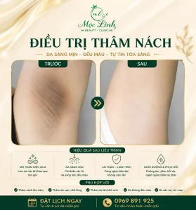 Trị thâm nách – bẹn Hải Phòng