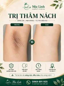 Trị thâm nách – bẹn Hải Phòng