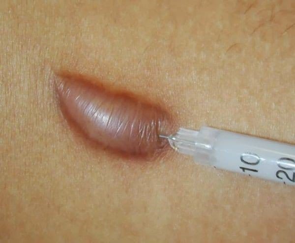 Các phương pháp chữa sẹo lồi | Vinmec