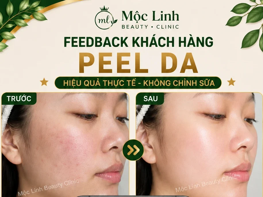 Peel Da Hải Phòng – Làn Da Cần Được Làm Mới Và Chăm Sóc Chuyên Sâu