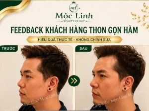 Tiêm Thon Gọn Hàm Hải Phòng