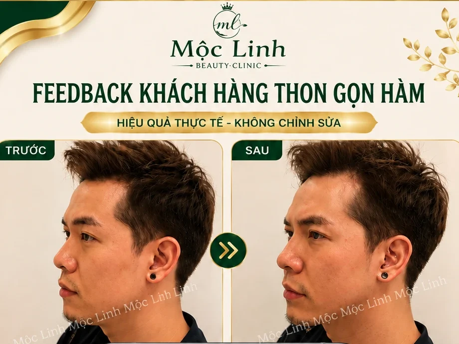 Tiêm Thon Gọn Hàm Hải Phòng