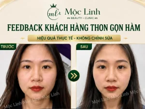 Tiêm Thon Gọn Hàm Hải Phòng