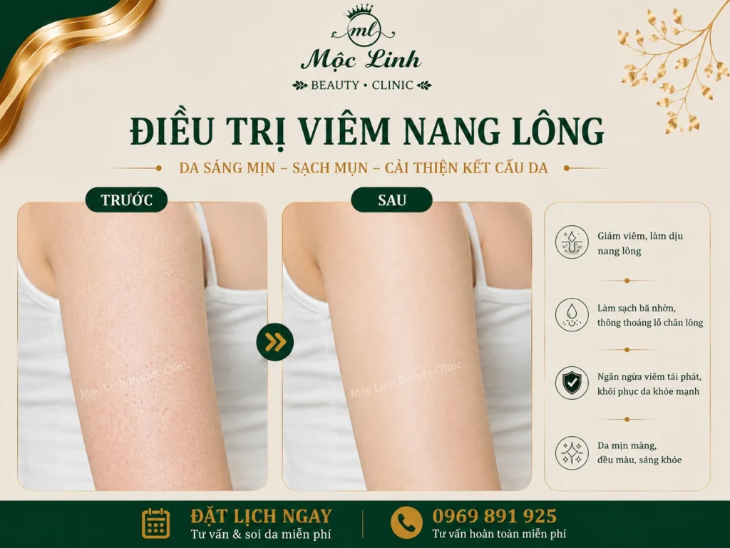 Điều Trị Viêm Nang Lông Hải Phòng – Giải Pháp Cho Vùng Da Thô Ráp Và Lông Mọc Ngược