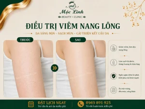 Điều Trị Viêm Nang Lông Hải Phòng – Giải Pháp Cho Vùng Da Thô Ráp Và Lông Mọc Ngược