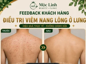 Điều Trị Viêm Nang Lông Hải Phòng – Giải Pháp Cho Vùng Da Thô Ráp Và Lông Mọc Ngược